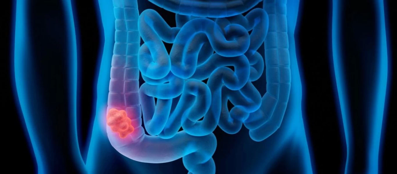 Οι 3+1 τροφές που μειώνουν τον κίνδυνο εμφάνισης καρκίνου του παχέος εντέρου